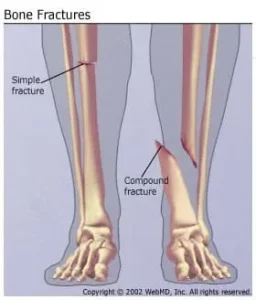Understanding Bone Fractures — the Basics